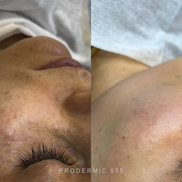 Before and after: Diffuse Hyperpigmentation