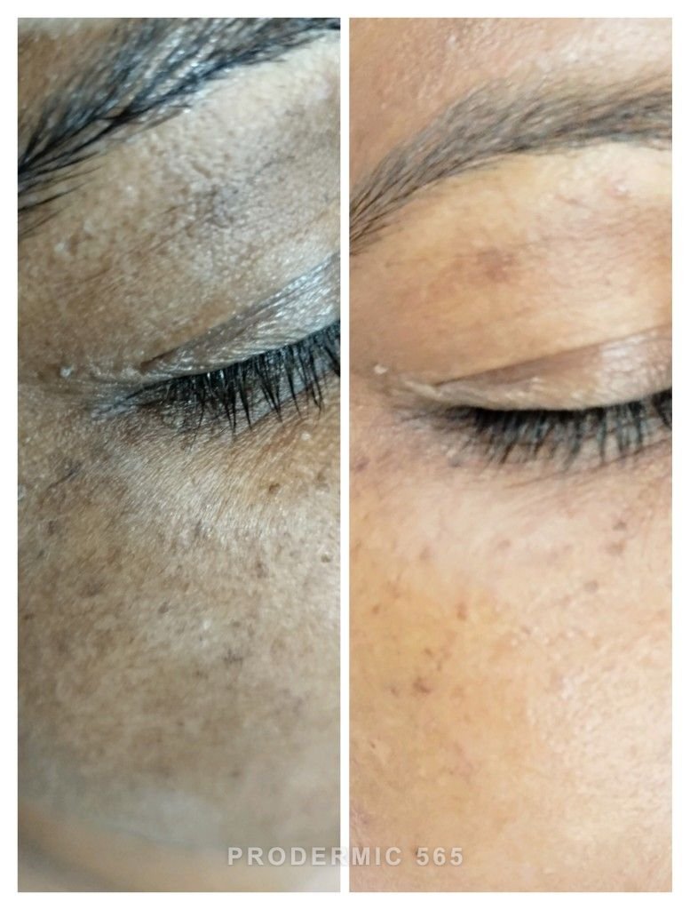 Before and after: Deep Pigmentation