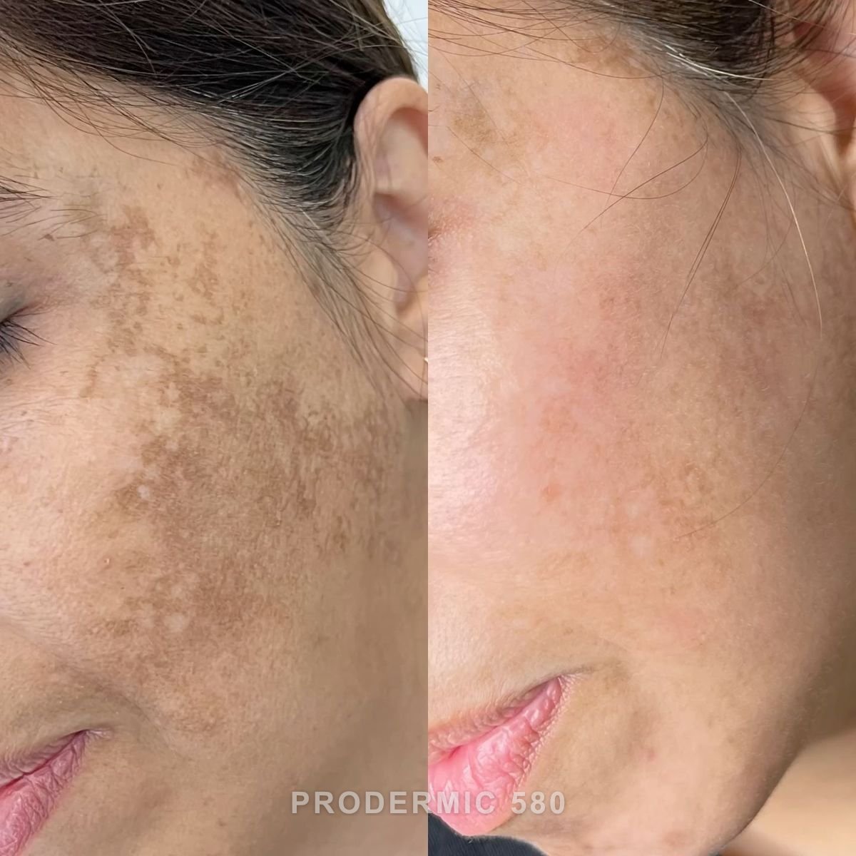 Before and after: Bilateral Malar Melasma