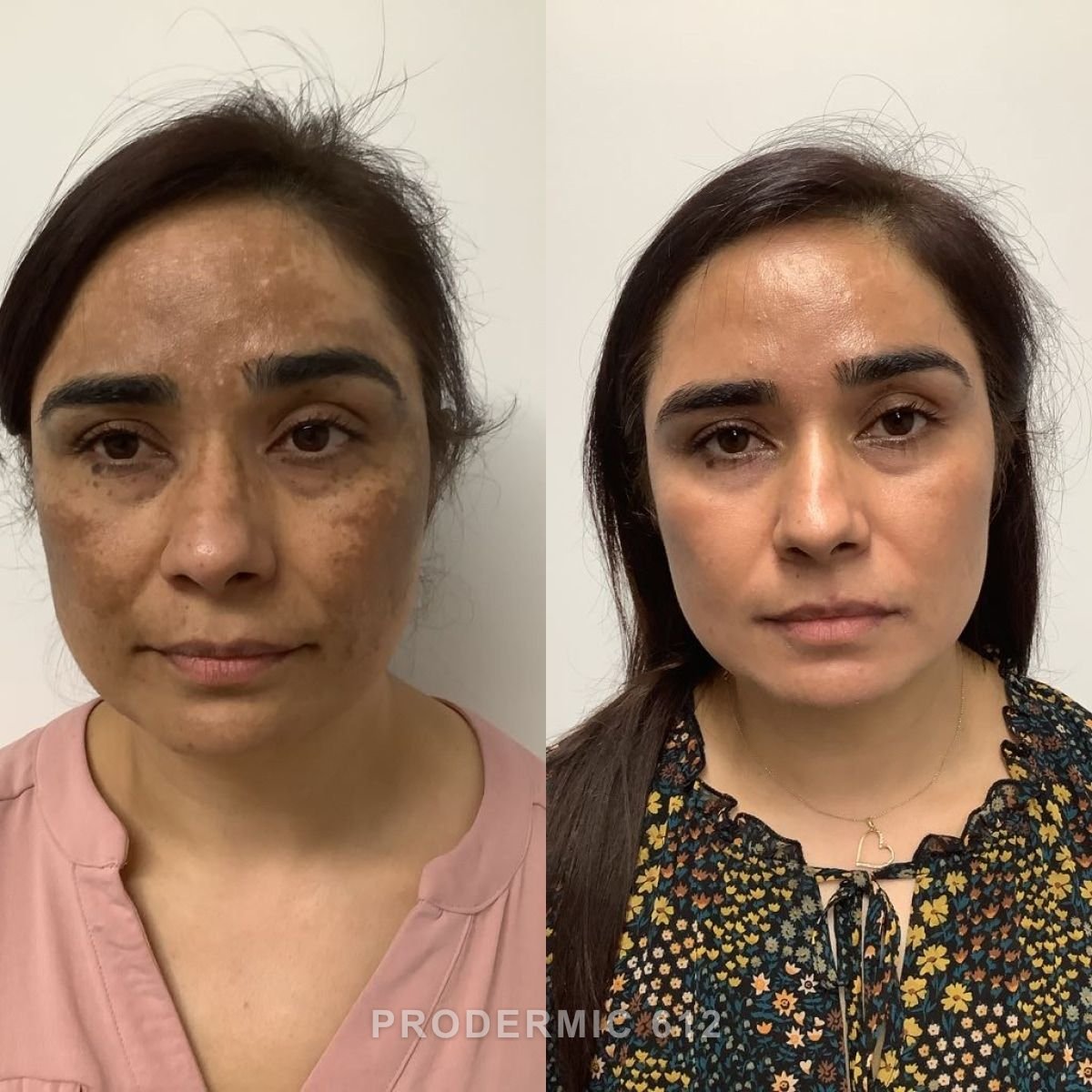 Before and after: Melasma