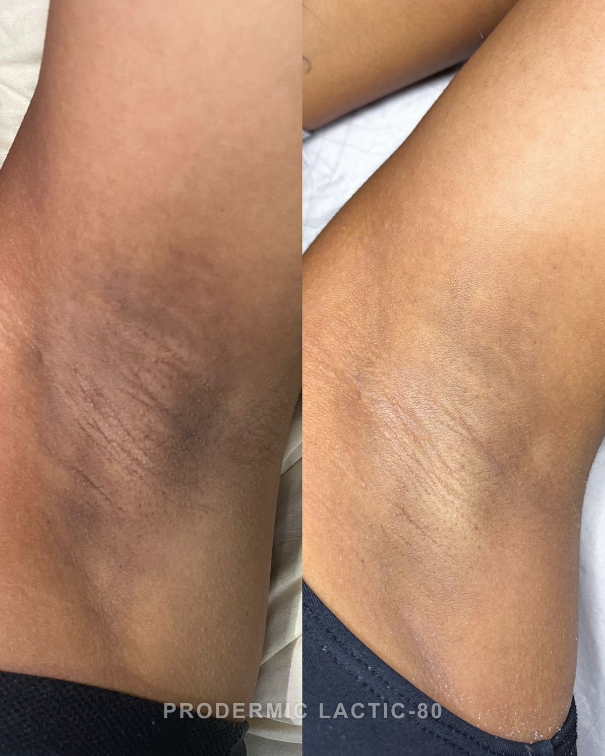 Before and after: Dullness + Texture