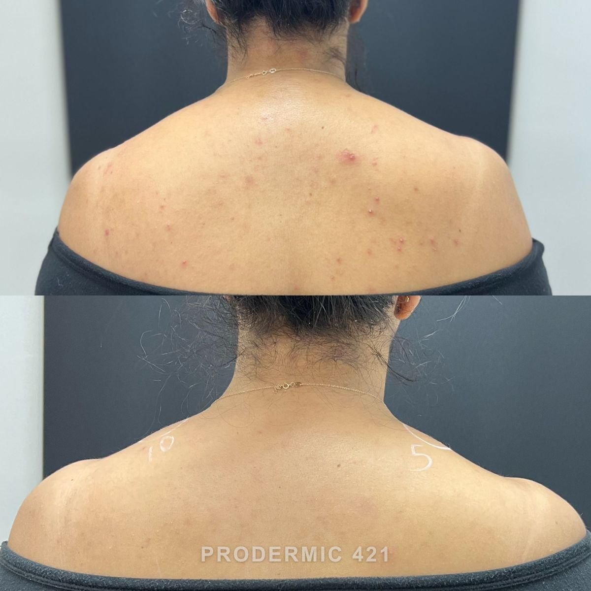 Before and after: Active Inflammatory Acne
