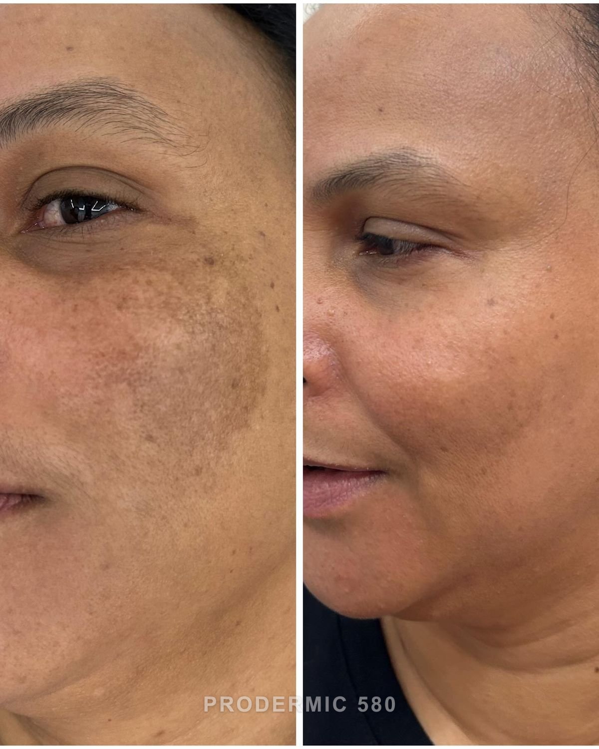prodermic 580 Melasma Protocol image 3