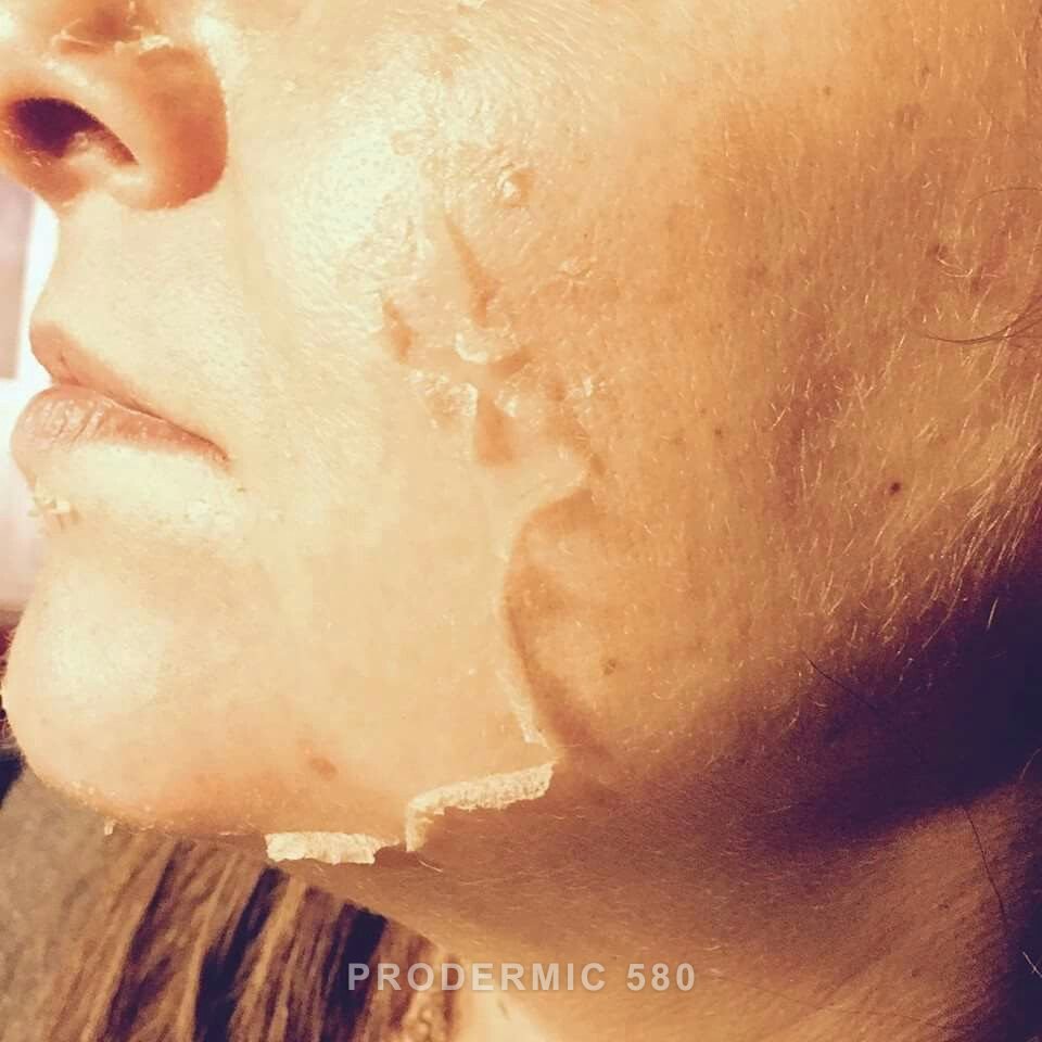 prodermic 580 Melasma Protocol image 4