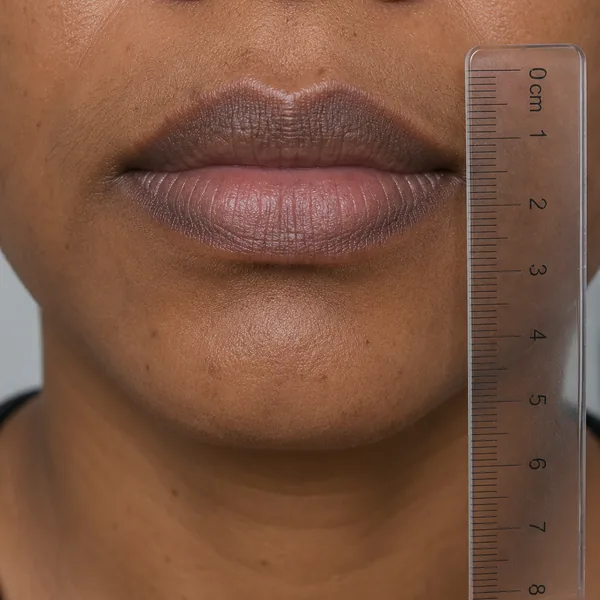 Lip Hyperpigmentation — clinical reference for Lip Protocol